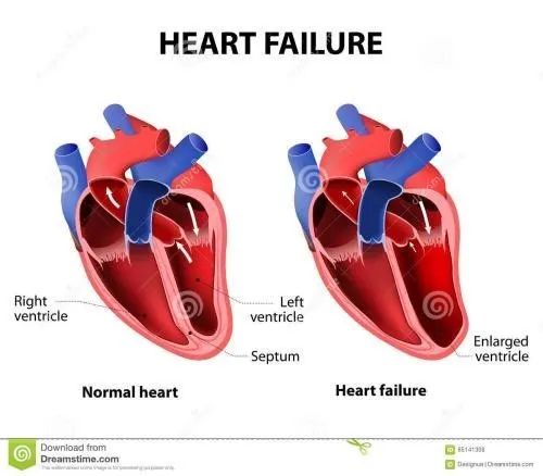 Pay attention to heart failure, and NT proBNP / BNP helps early diagnosis and treatment